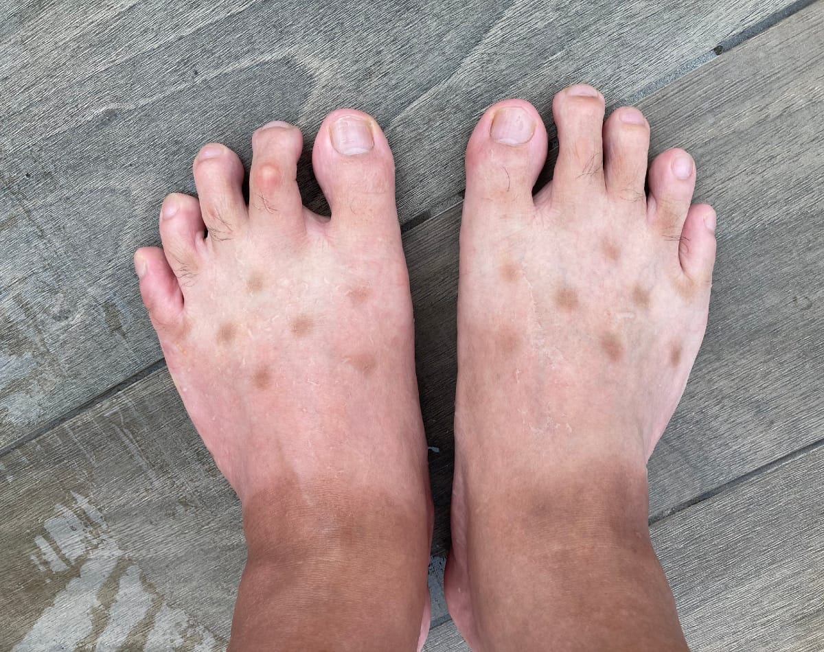 Strange Foot Disease Has a Simple Diagnosis grape Japan