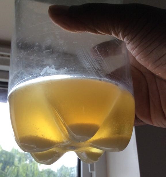 49 White Specks In Urine Background Ammirasoi Images and Photos finder