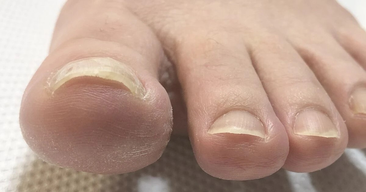 巻き爪ケア・ネイルトリムについて☆ 巻き爪について サロンからのお得な情報や新しいデザインを配信 巻き爪なら大阪のPrivate