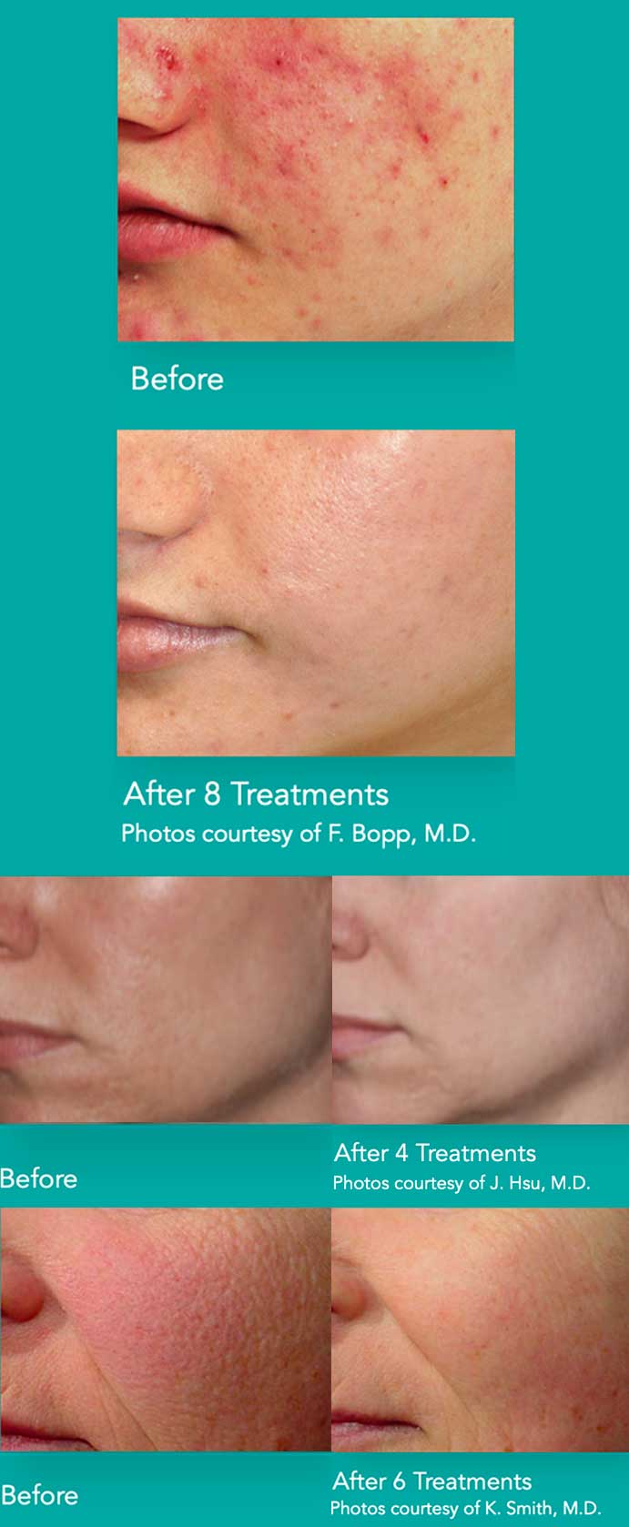 Laser Genesis Great Falls OBGYN Associates