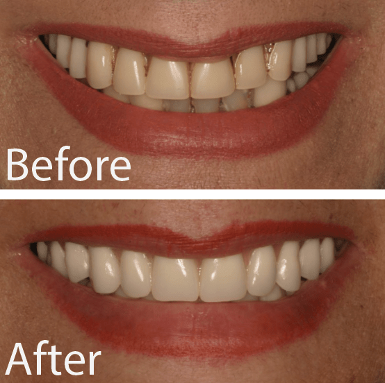 Patient Gallery Great Neck's Top Dental Implant Solution