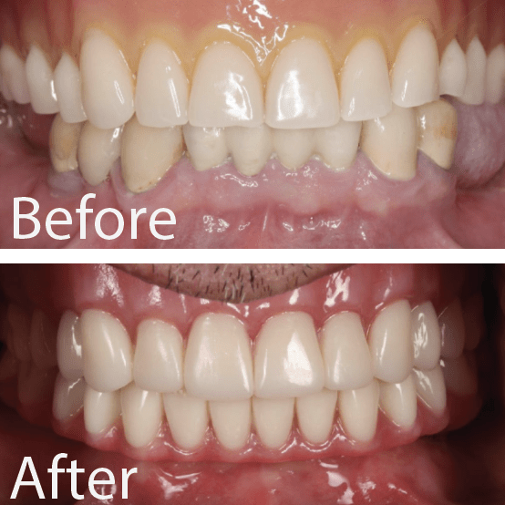 Patient Gallery Great Neck's Top Dental Implant Solution
