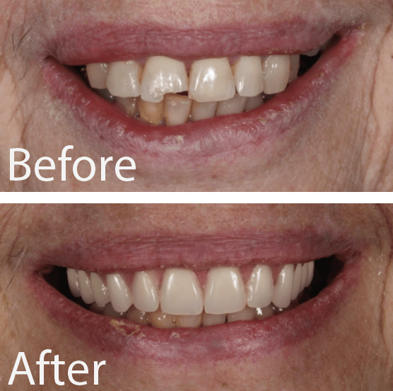 Patient Gallery Great Neck's Top Dental Implant Solution
