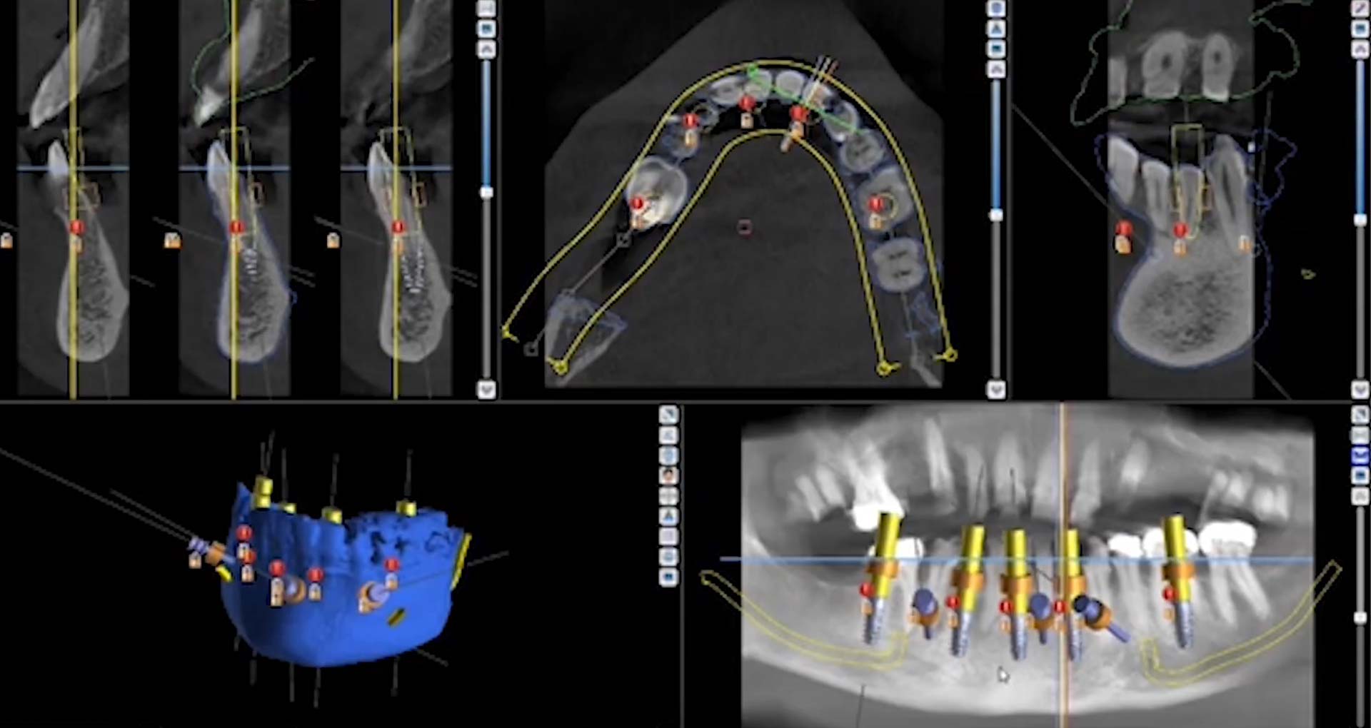 Technology Great Neck's Top Dental Implant Solution