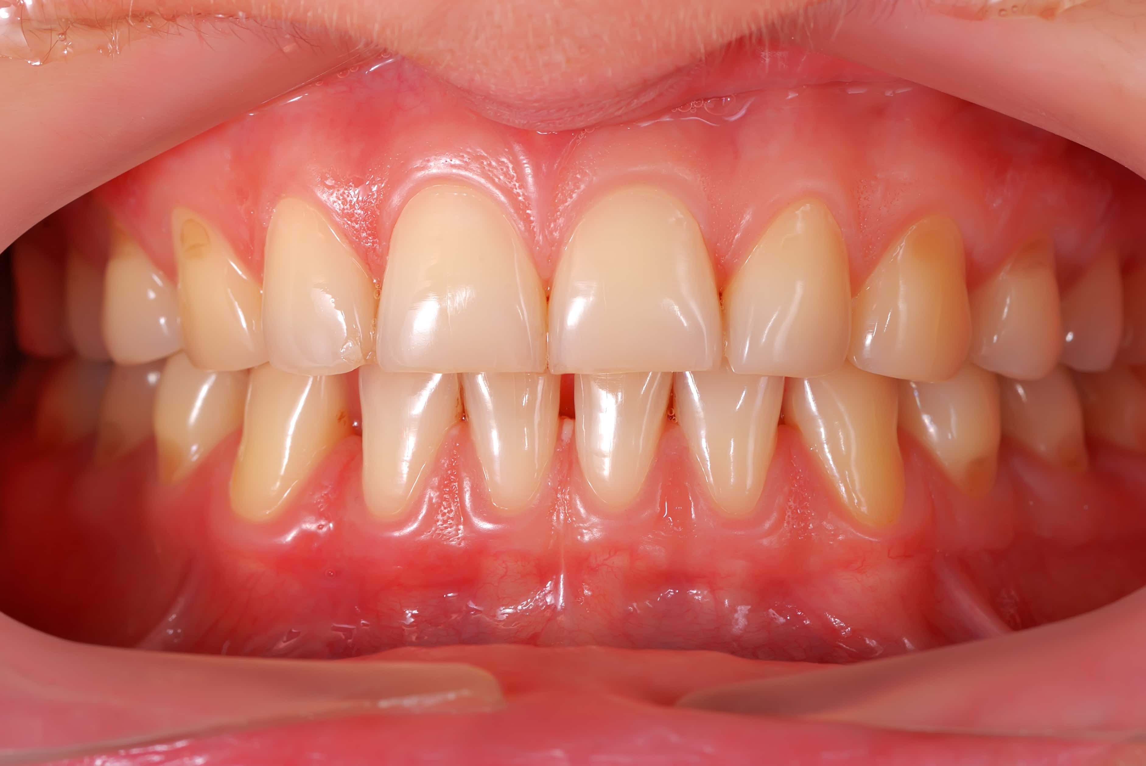 Experiencing Gum Inflammation? Try Scaling and Root Planing Baxter, MN