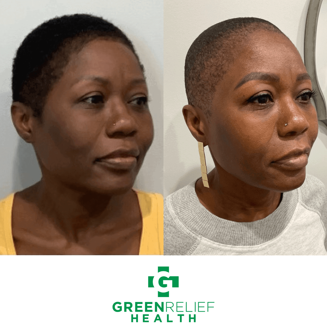 Before & After Microneedling Green Relief Health
