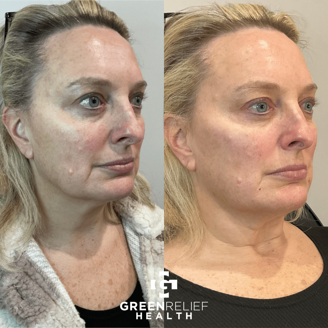 Before & After Dermal Filler Green Relief Health