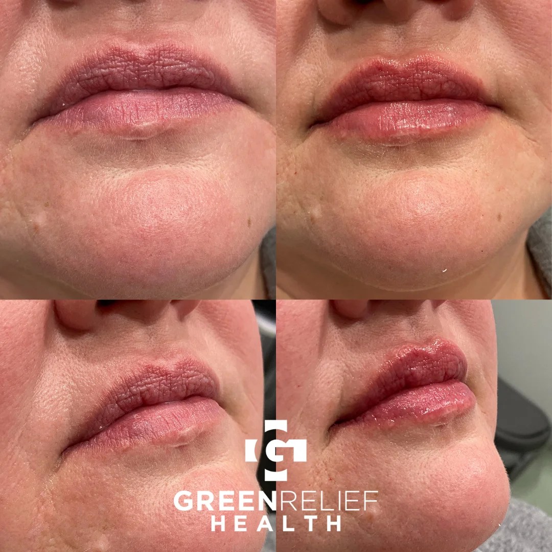 Before & After Dermal Filler Green Relief Health