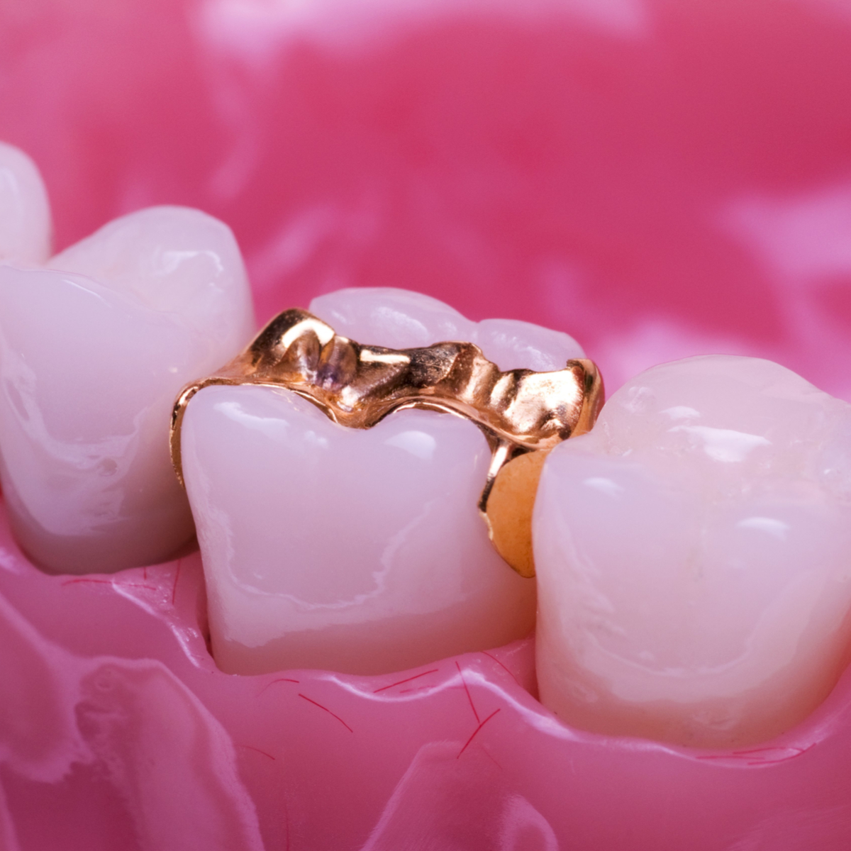 Inlays and Onlays vs. Full Coverage Dental Crowns