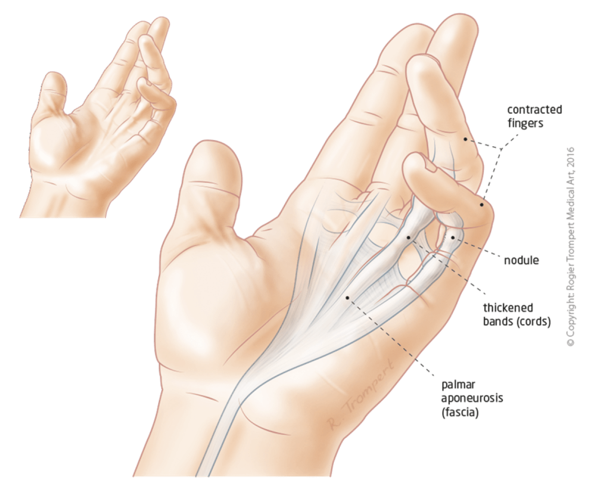 Dupuytren's disease surgery Grip Hand & Wrist Surgery
