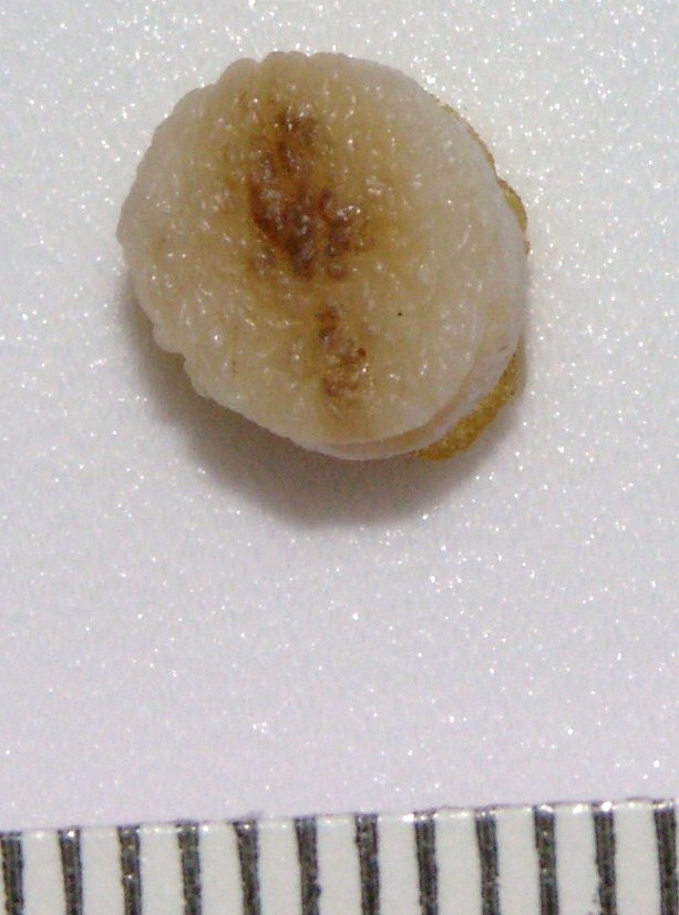 Punch biopsy Archives GROSSING TECHNOLOGY in SURGICAL PATHOLOGY