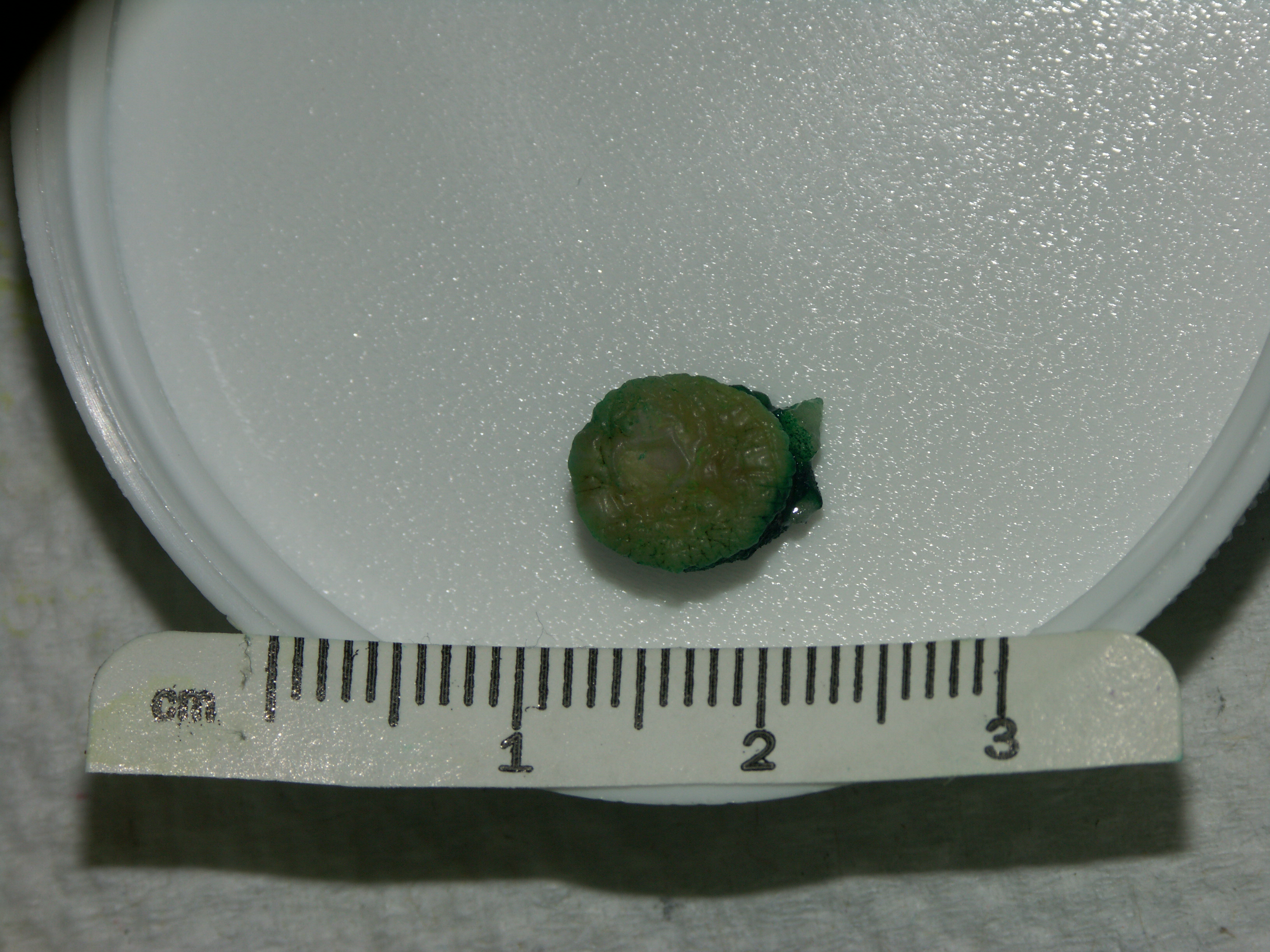 Punch biopsy Archives GROSSING TECHNOLOGY in SURGICAL PATHOLOGY