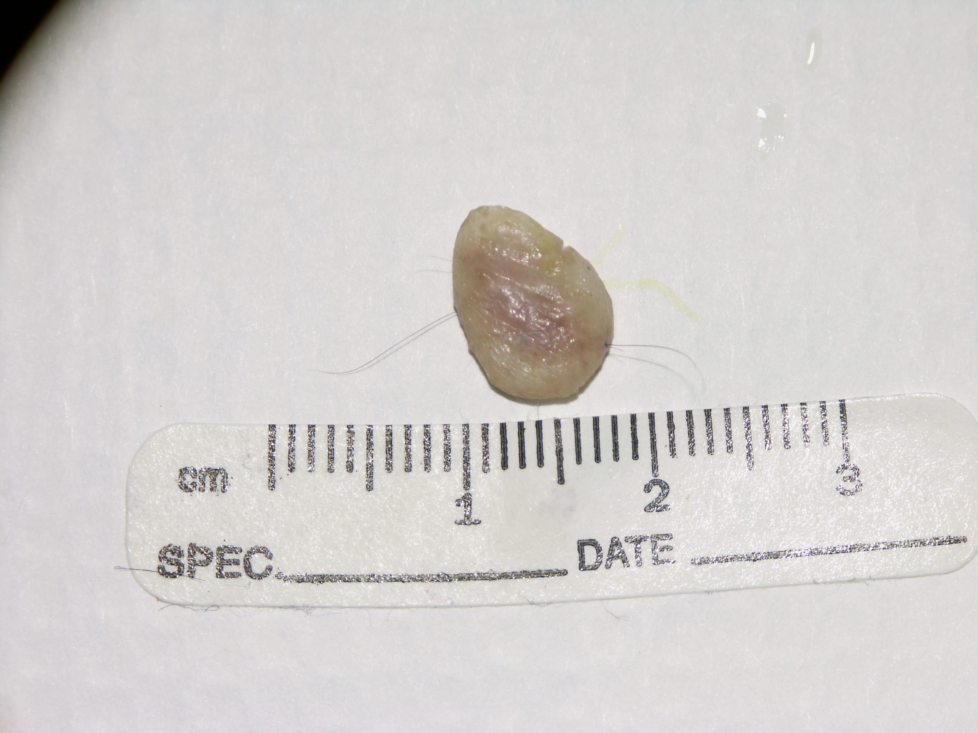 Punch biopsy Archives GROSSING TECHNOLOGY in SURGICAL PATHOLOGY