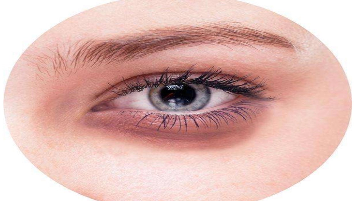 What causes dark circles around the eyes in adults GrowMoreHealth