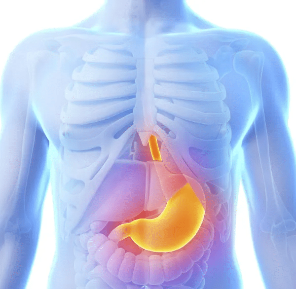 Qué es reflujo gastroesofágico 6 síntomas y tratamientos