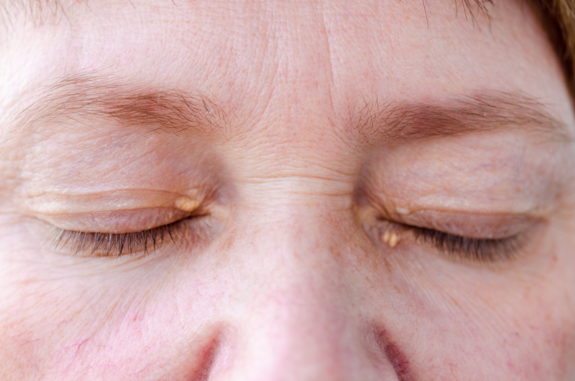 Xanthelasma Palpebrarum can Plexr® be the solution? GMV Medical