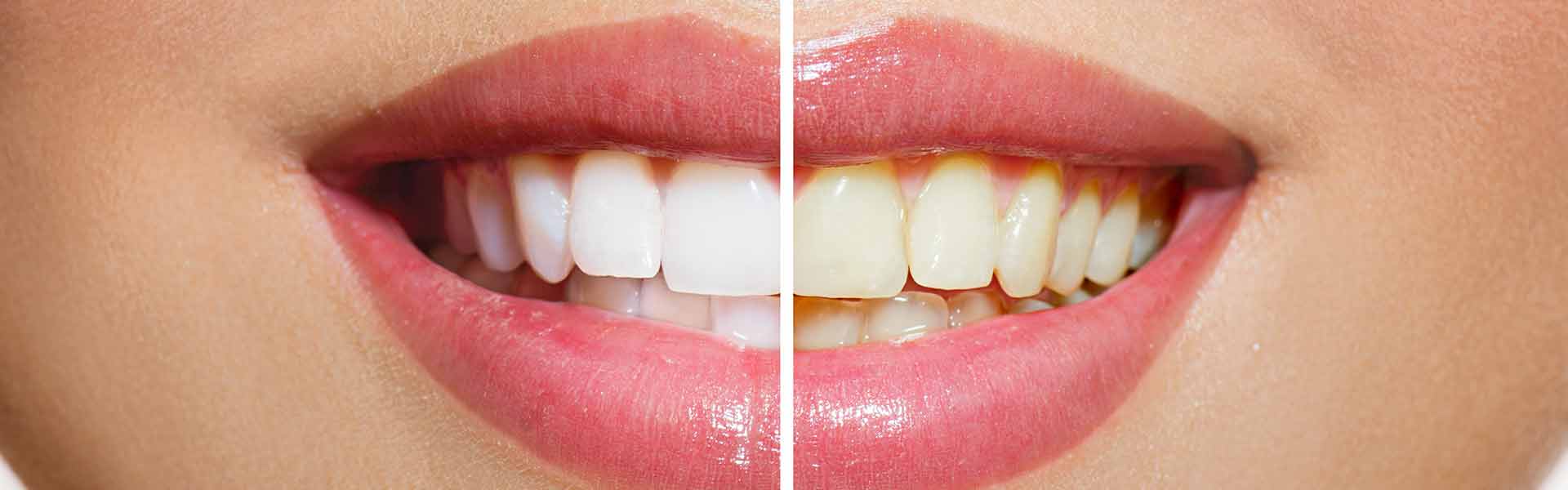 Teeth Whitening In Colorado Springs Guerra Dental Dr. Guerra