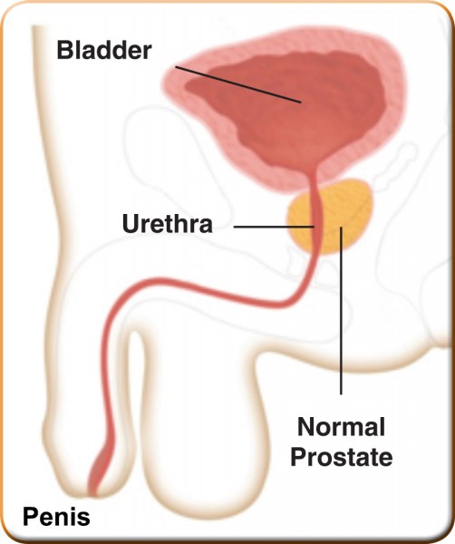 About UroLift® for BPH Gulfstream Urology Associates, P.A. Dr. Adam