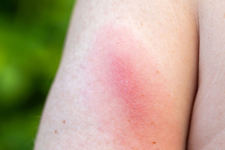 Lyme İgg/İgm Ab Nedir? Güncel Oku