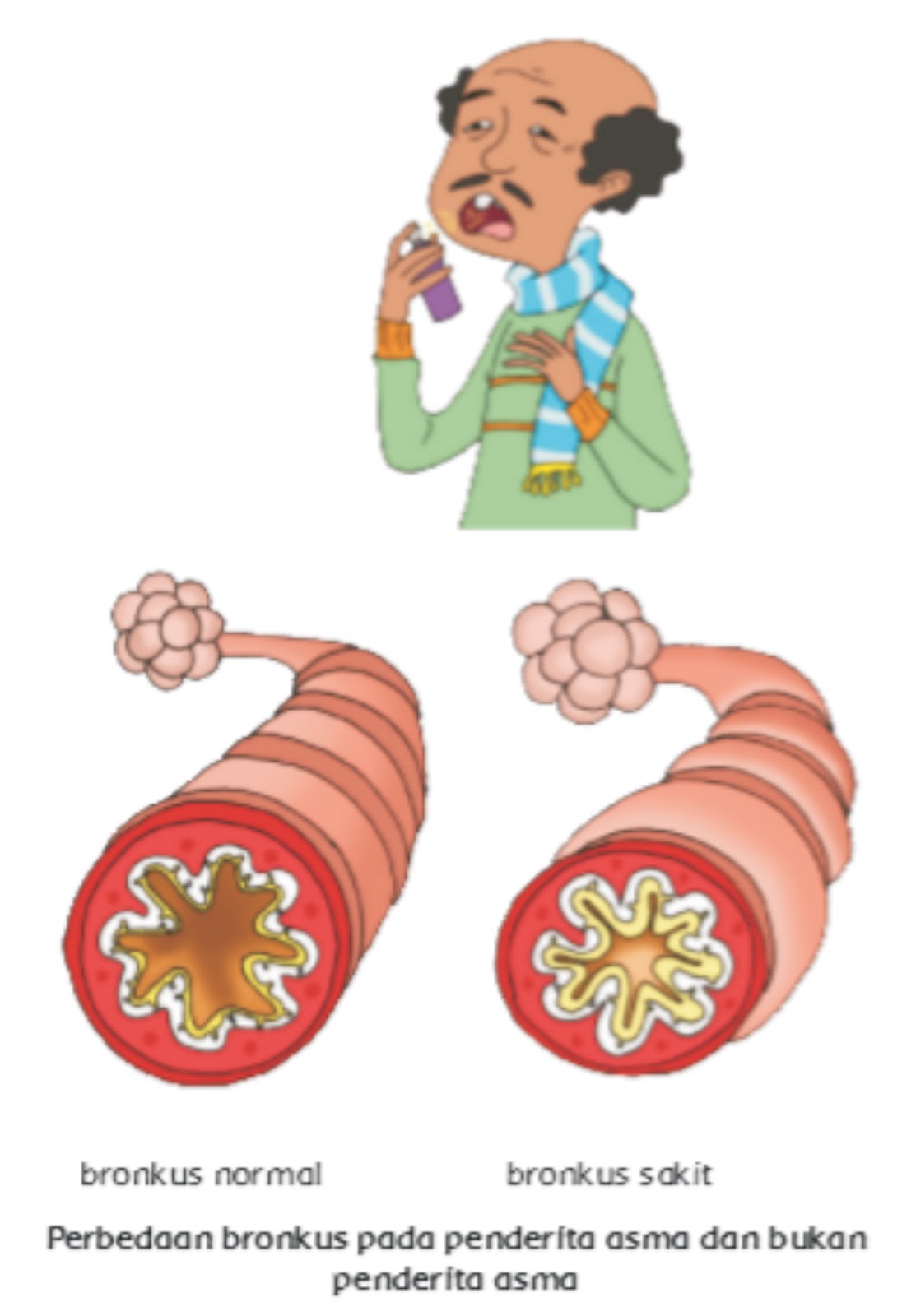 Penyakit Asma ( Kunci Jawaban Tema 2 Sub Tema 2 Pembelajaran 2 Kelas 5