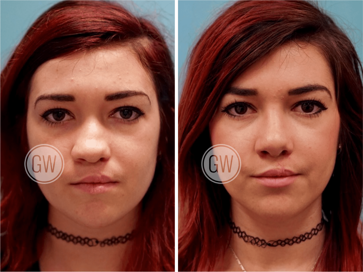 Cleft Rhinoplasty + Septoplasty + Lip Revision Dr. Guy Watts