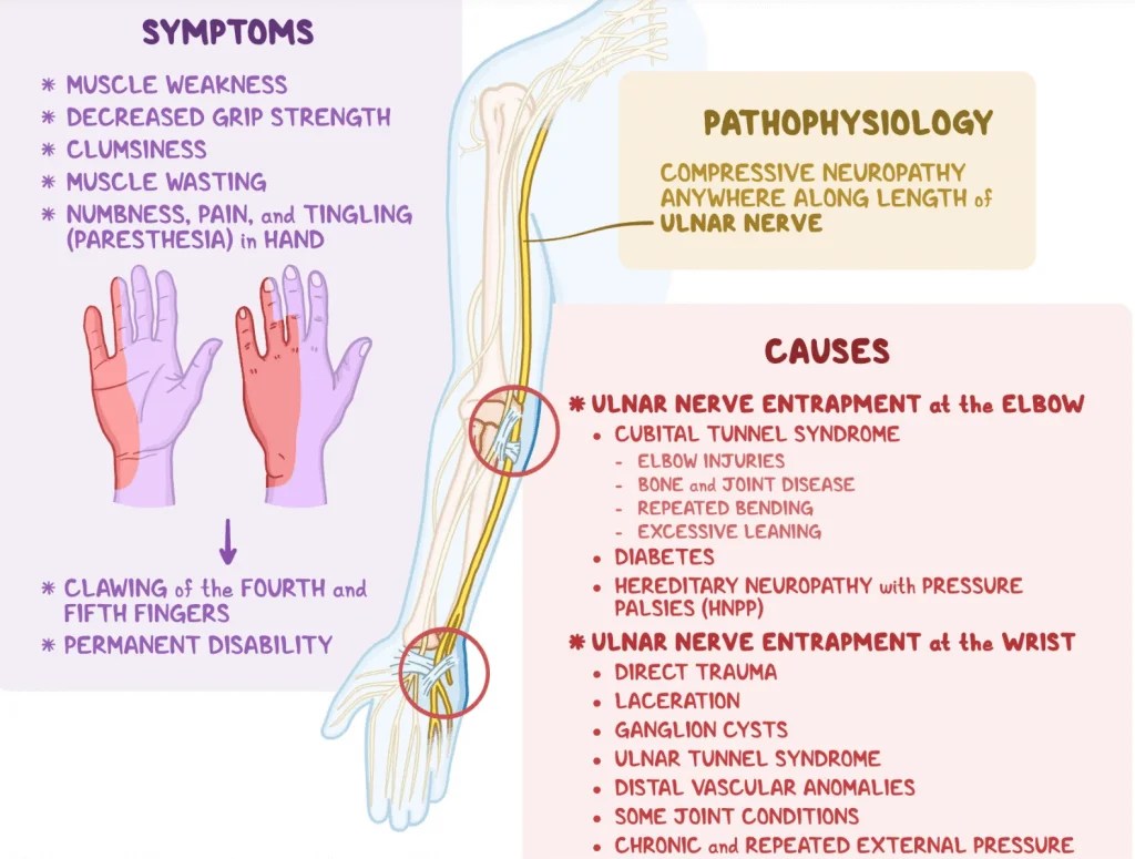 How To Fix Ulnar Nerve Entrapment Causes & Symptoms Gymless