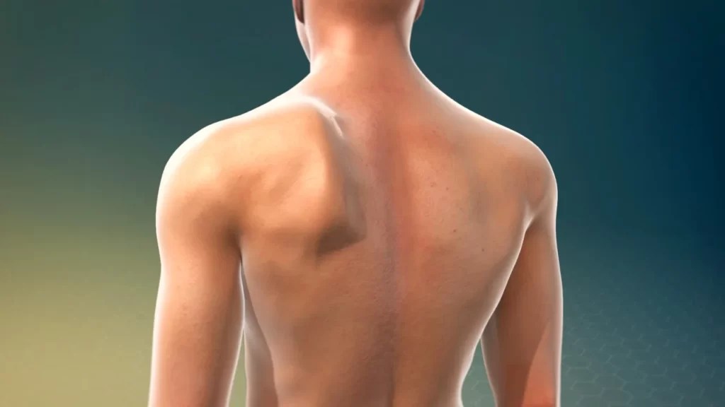Winged Scapula What Is It and How Do I Stop It? Gymless