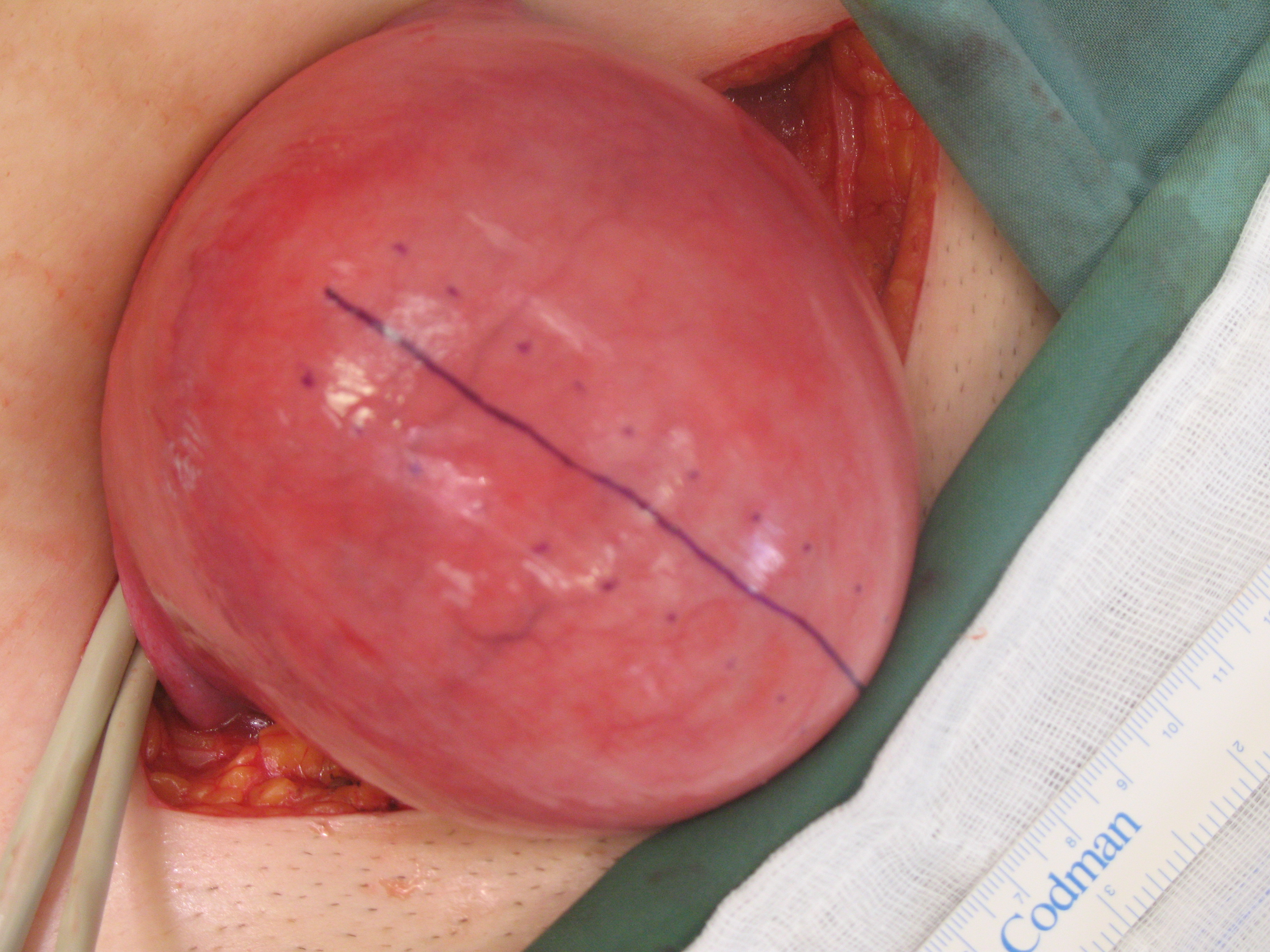 Myomectomy