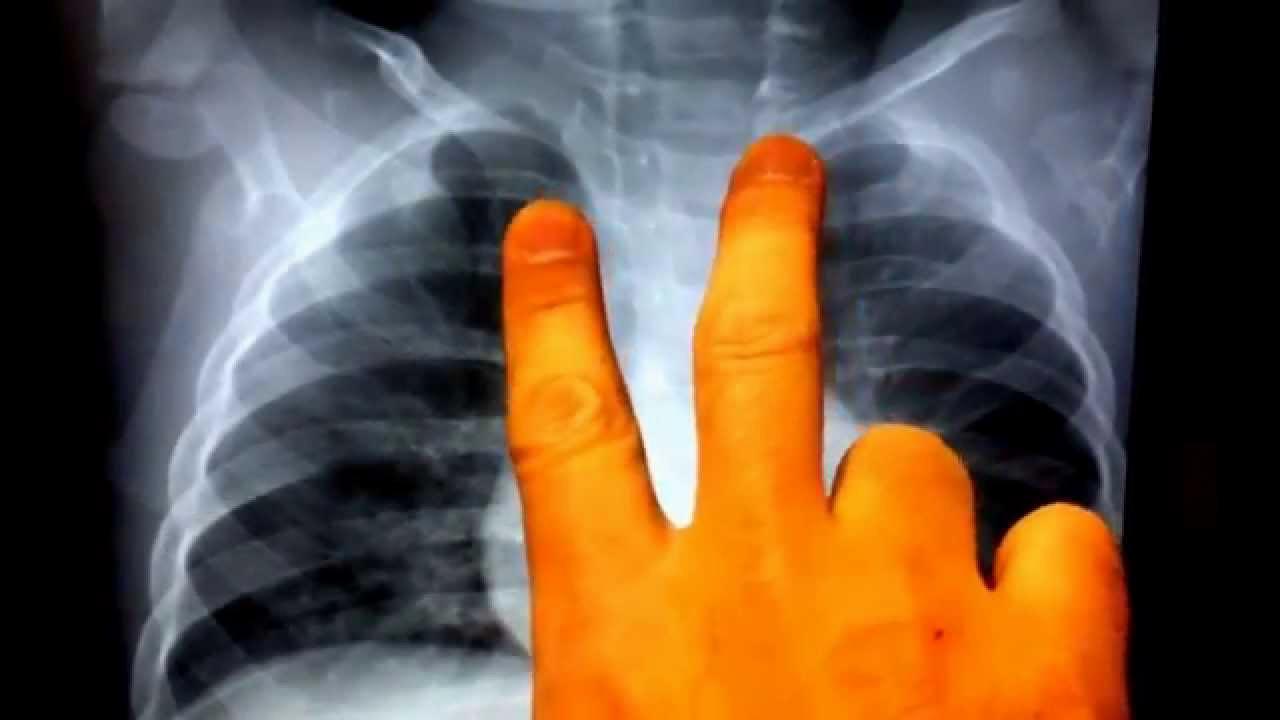 Peribronchial Cuffing Explained