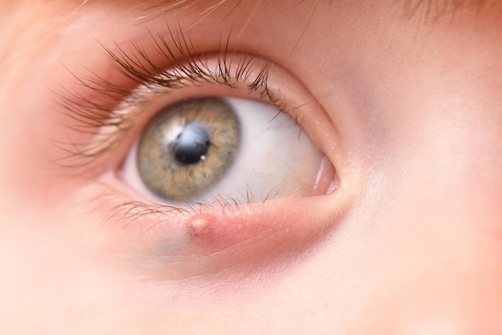 Stye Causes, Care and Treatment