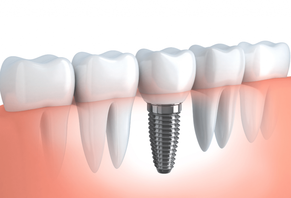 Dental Implants Maryland Best Permanent Solutions Hackley DDS