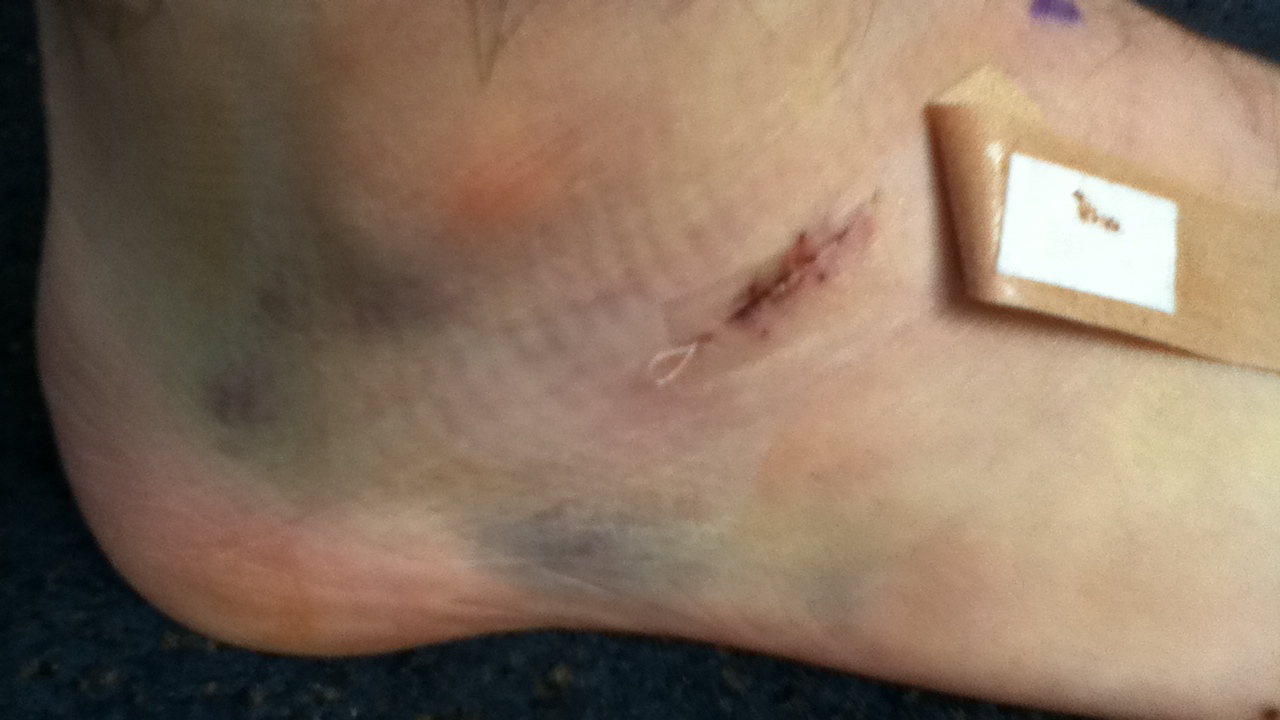 Bruised Heel Bone Treatment How To Heal It At Home.