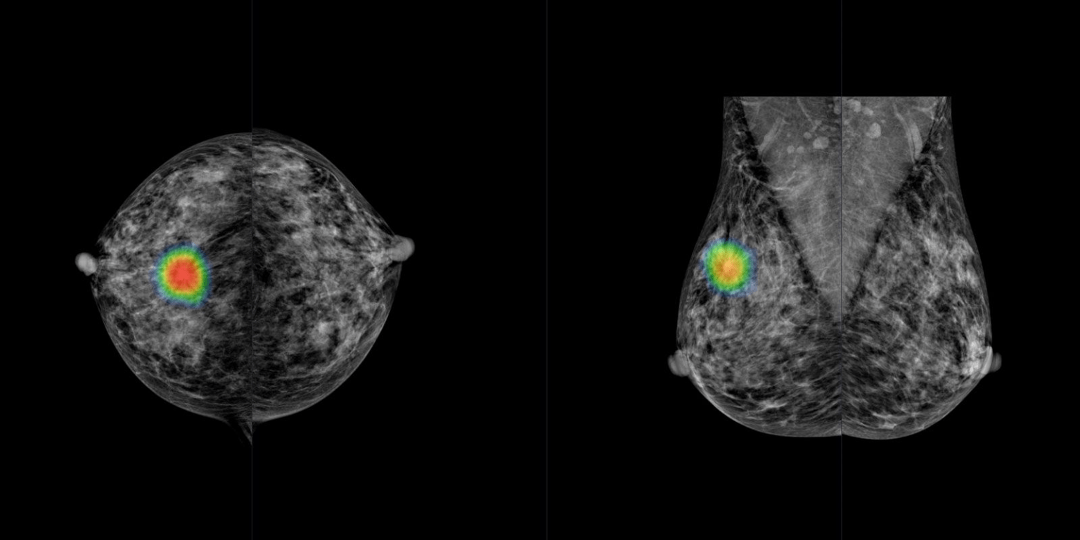 AI Solution for Breast Cancer Early Detection(Korean AI Technologies
