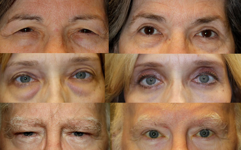 Blepharoplasty Haik Humble Eye Center
