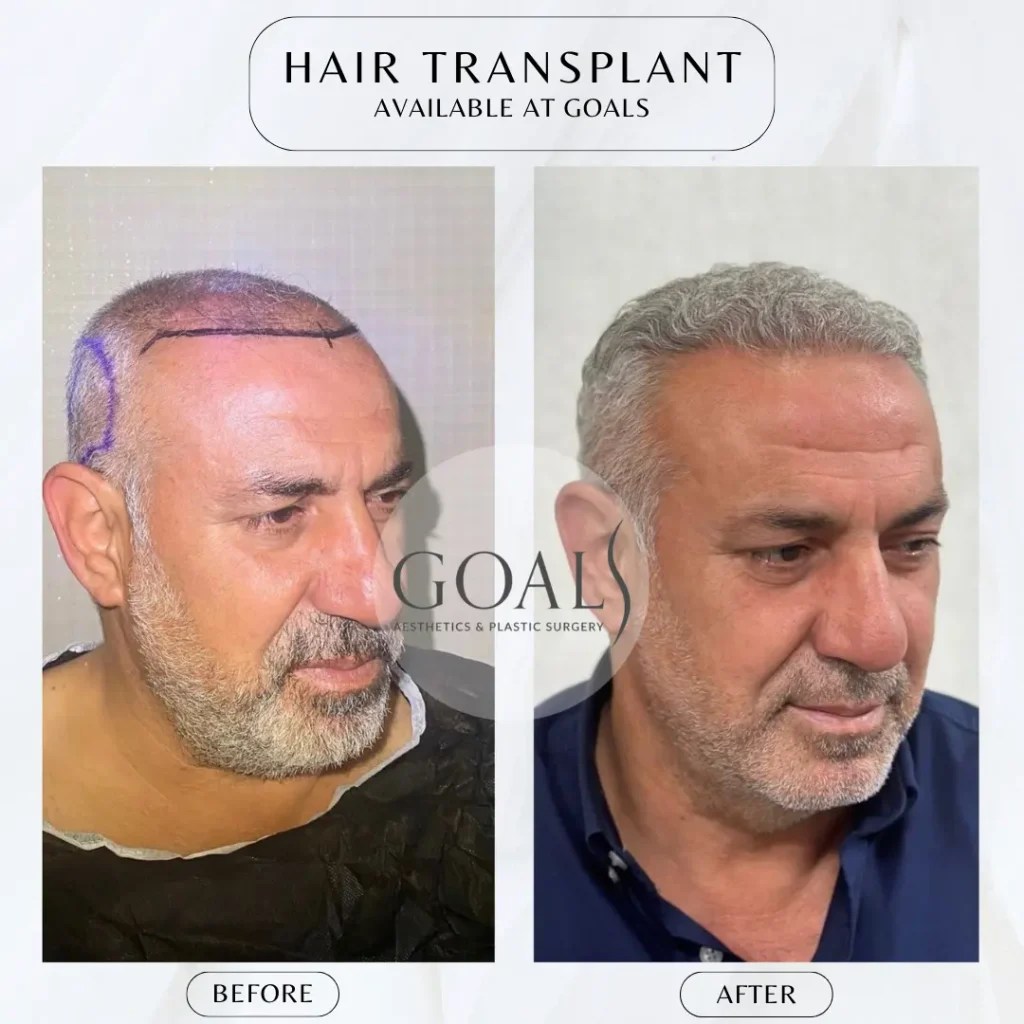 Goals Plastic Surgery® Transform with Goals Plastic Surgery® 11