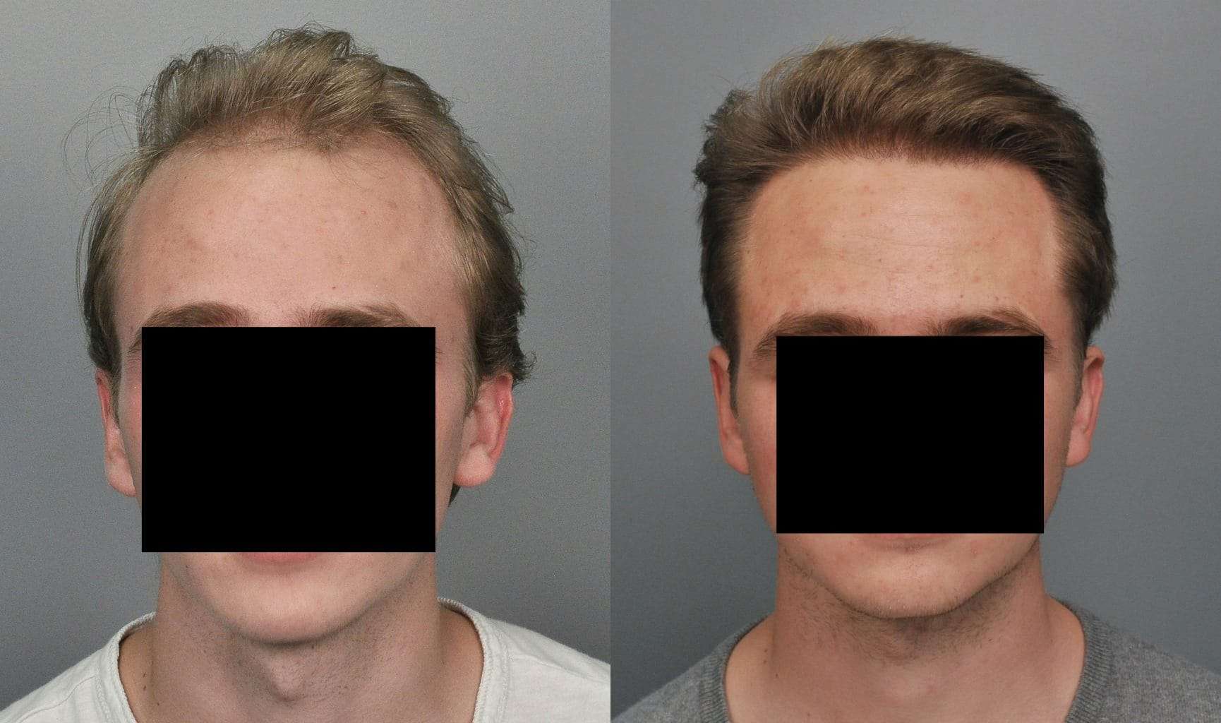Before & After Photo Gallery Cooley Hair Center Charlotte, NC