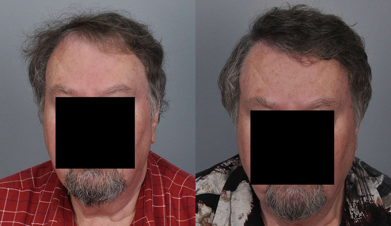 Before & After Photo Gallery Cooley Hair Center Charlotte, NC