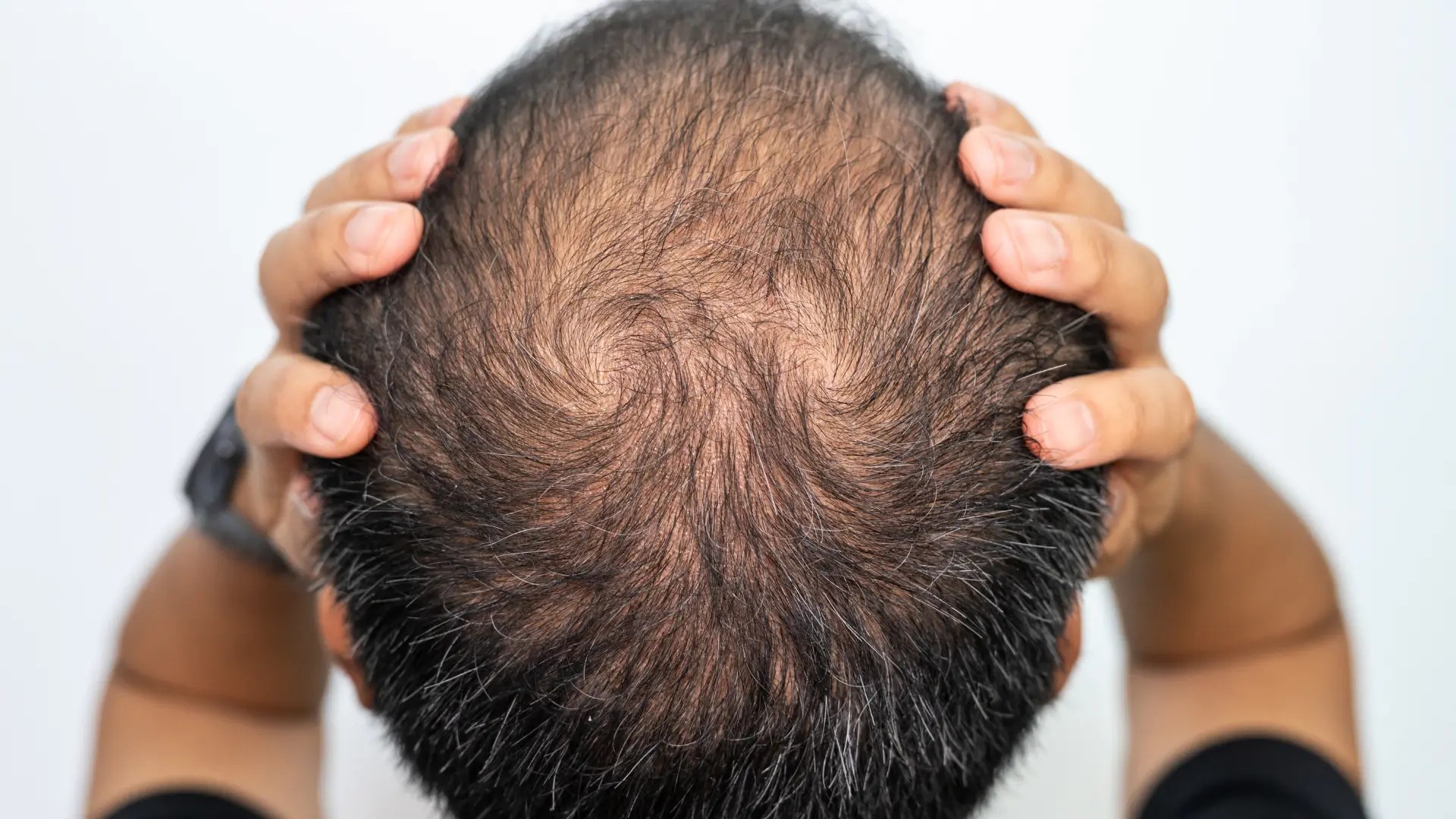 Does Gabapentin Cause Hair Loss? All You Need to Know