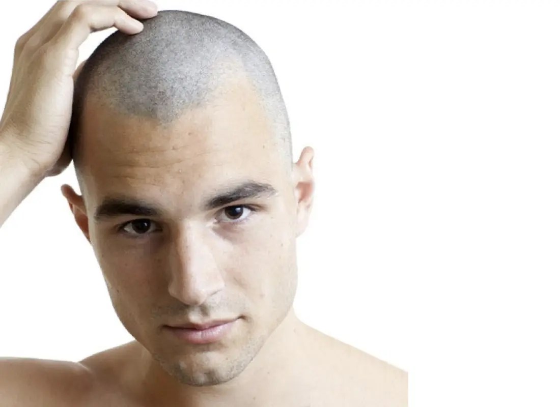 SMP Advanced Scalp Micro Pigmentation HairOptions SA