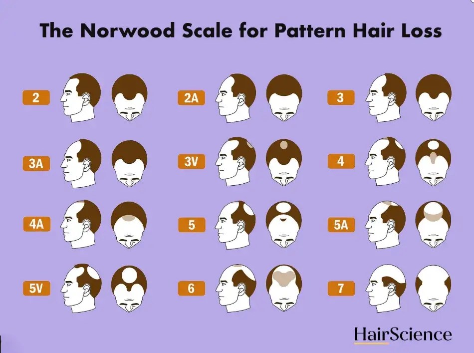 Norwood Scale Stages of Male Pattern Baldness