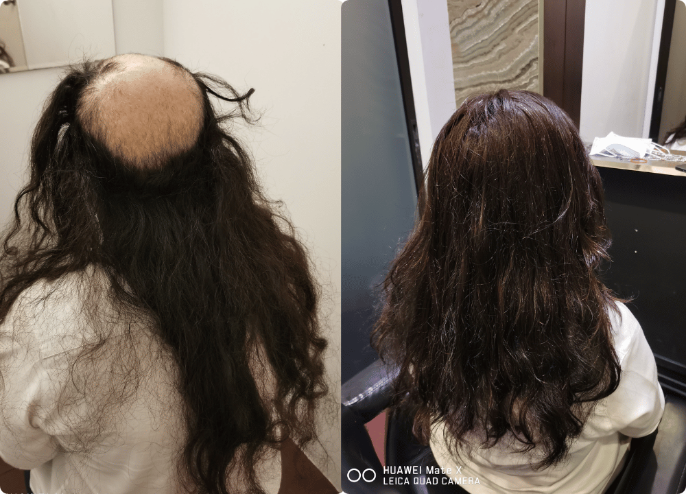 Hair Replacement Cost Singapore Hairspec Hair Loss Specialist