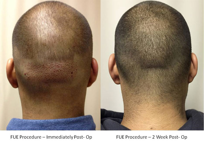 FUE Hair Transplant Edison, NJ Follicular Unit Extraction