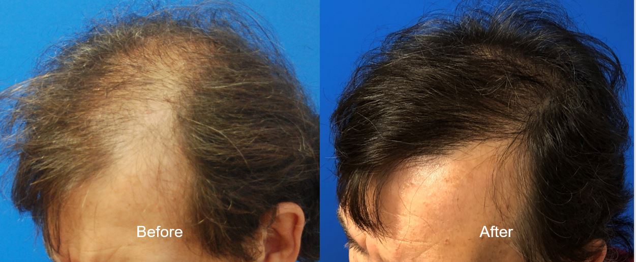 2000 FUT Graft Hair Transplant Combthru at 12 months postop Hair