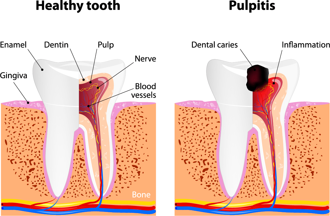 Facts About Tooth Decay Hale Family Dentistry