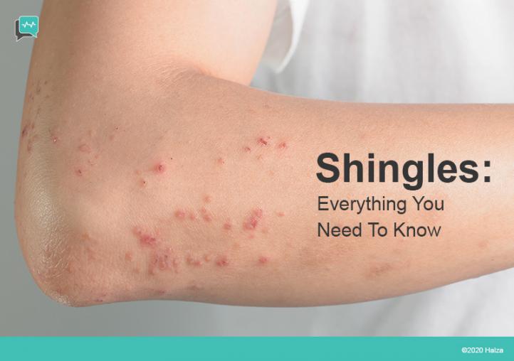 What are Shingles? Halza