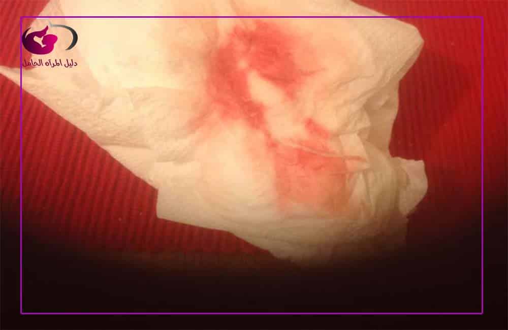 شكل دم الحمل بالصور تعرفي على علامات واسباب نزول دم الحمل دليل المرأة الحامل