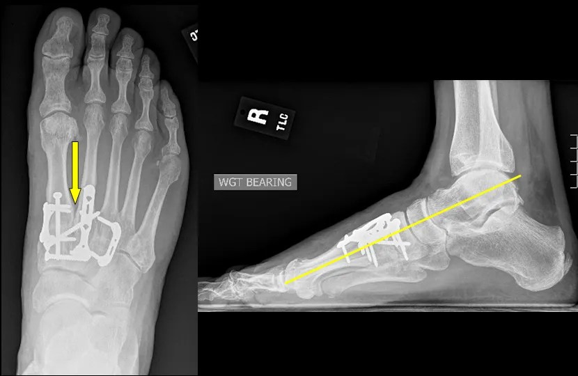 Midfoot Arthritis Dr Hamish Curry Foot & Ankle Surgeon
