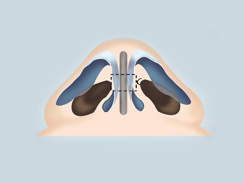 NonArtificial Material Rhinoplasty HANABI RHINOPLASTY CLINIC