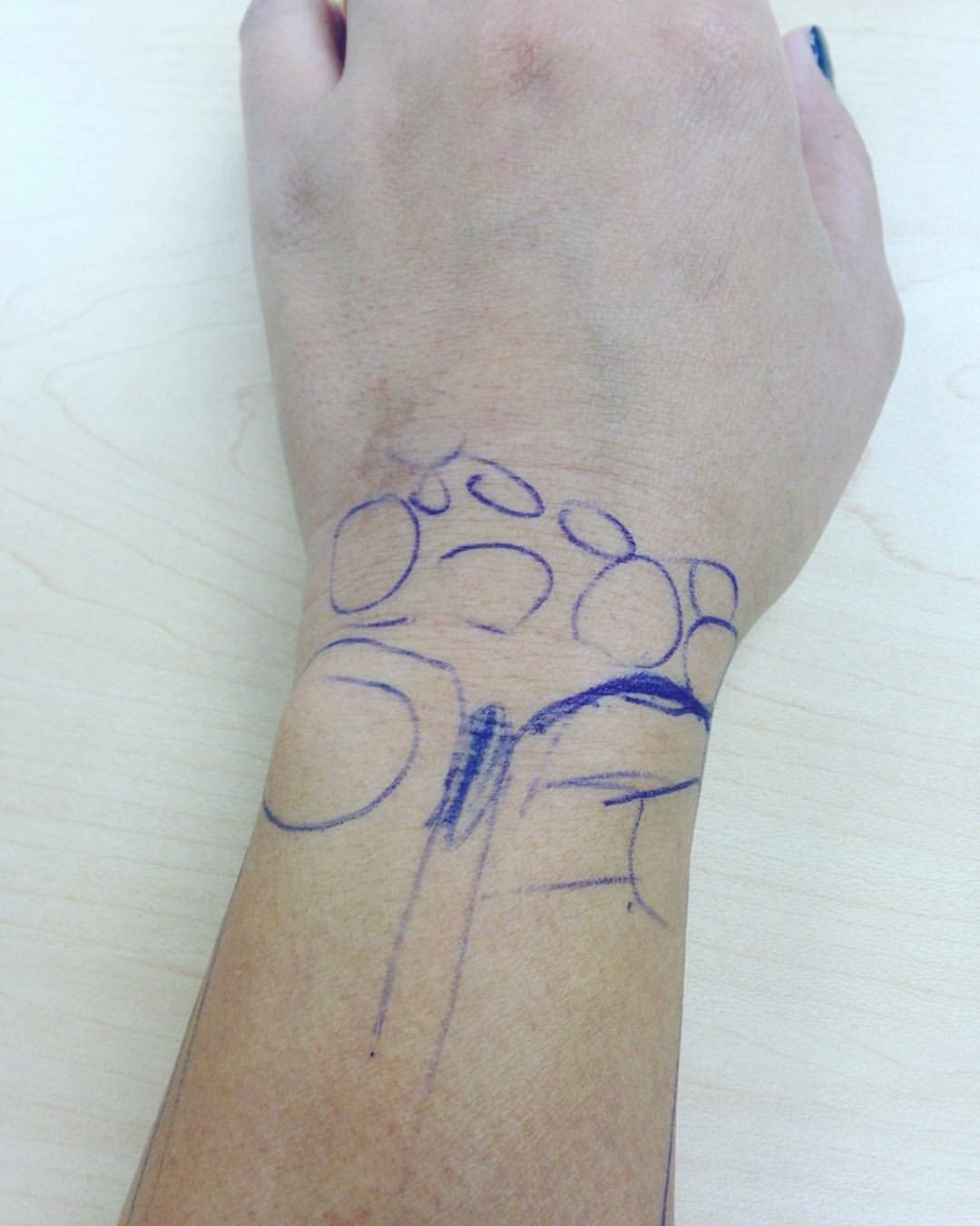 Occupational Therapy For Wrist Fracture Hands on Therapy