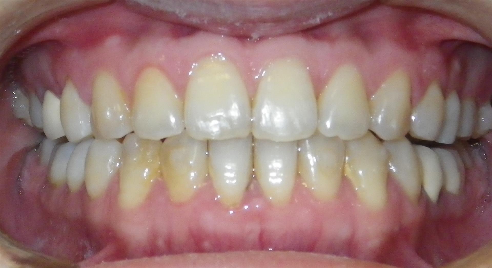 Louisville Teeth Straightening Retainers & Clear Braces Oliver